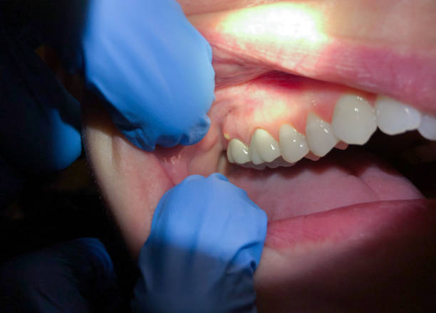 Best Urgent Care for Lost Fillings or Crowns in Crystal, MN